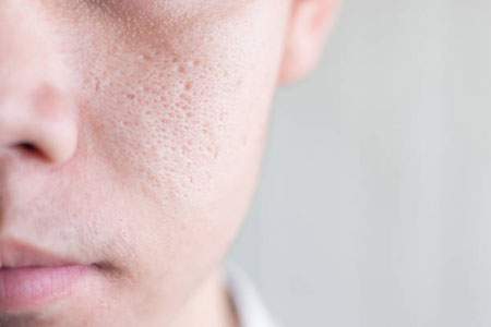 منافذ باز پوست صورت چگونه درمان می شود؟