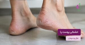 خشکی پوست پا