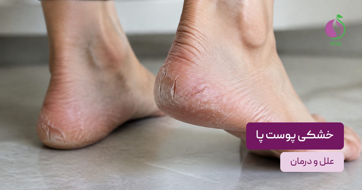 خشکی پوست پا