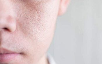 منافذ باز پوست صورت چگونه درمان می شود؟
